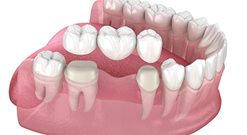 a 3d illustration of a traditional dental bridge 