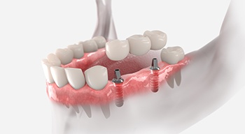 a 3d illustration of an implant-supported dental bridge