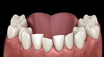 Illustration of crooked teeth