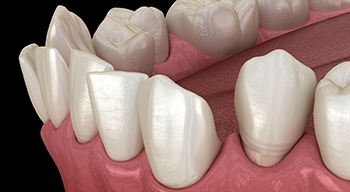 Illustration of gapped teeth