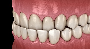 Illustration of an underbite