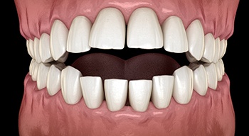 Illustration of an open bite