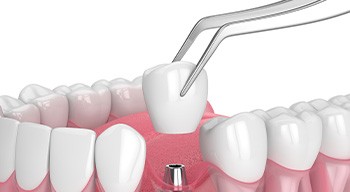 Illustration of single dental implant