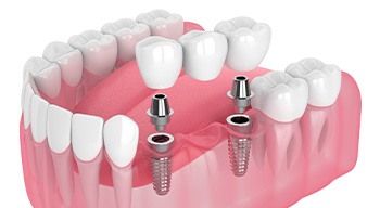 Illustration of implant bridge
