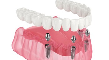 Illustration of implant denture