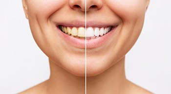 Closeup of patient's smile before and after teeth whitening